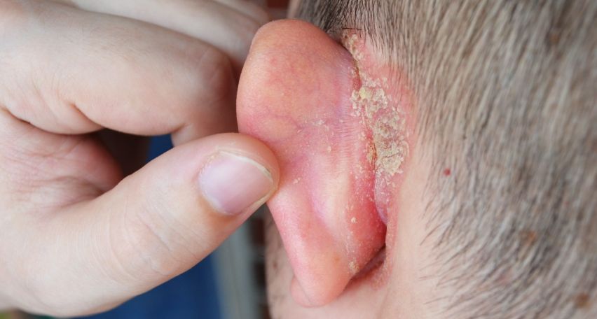 Seborrheic Eczema In Ear